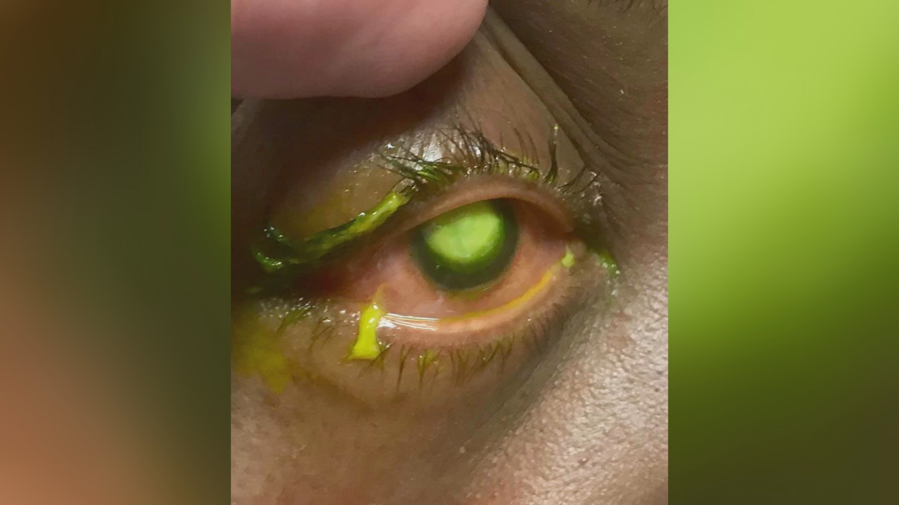 eye doctor warns against sleeping in contacts-846653543